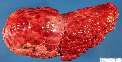 Cómo eliminar la cirrosis del hígado