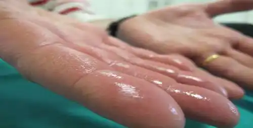 Cómo evitar la sudoración excesiva o hiperhidrosis
