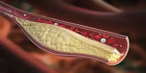 Cómo limpiar las arterias con mejor alimentación